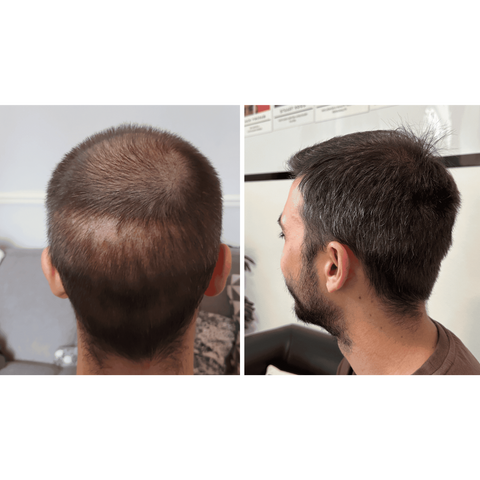 Platelet-Rich Plasma (PRP) Therapy