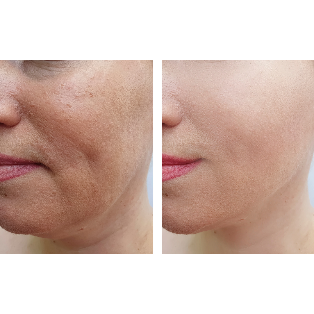 Microneedling