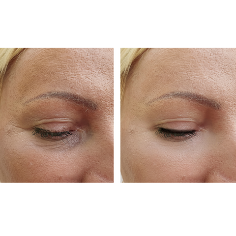 Microneedling