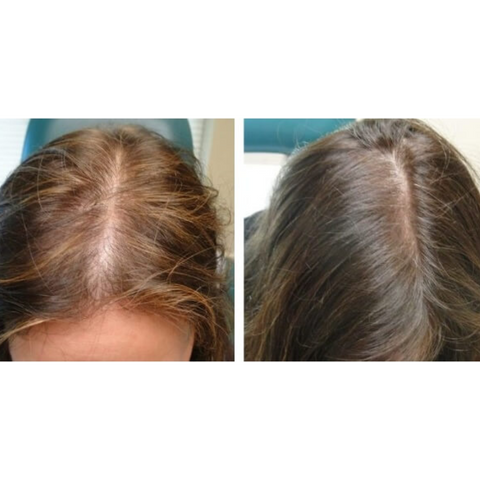 Platelet-Rich Plasma (PRP) Therapy